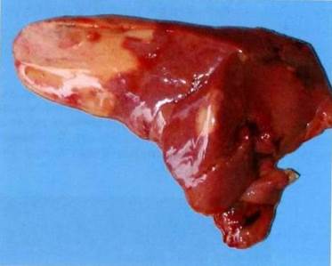 Жирове переродженя печінки у курей  (Гепатоз)