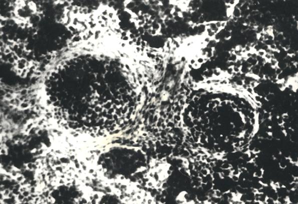 Гистотопограмма диафиза бедренной кости курицы (240 суток) гематоксилин и эозин, МБИ-6, х80: 1 – лимфоидные узелки (Криштофорова Б. В., 1992)